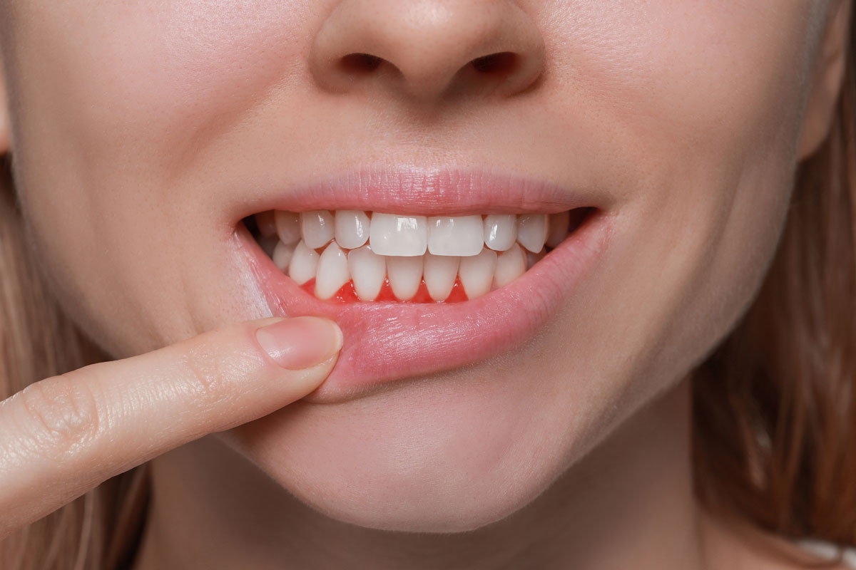 Advanced periodontitis showing gum recession and bone loss