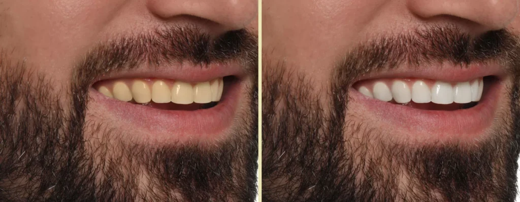 Before and after smile transformation at Pearl32 Dentistry