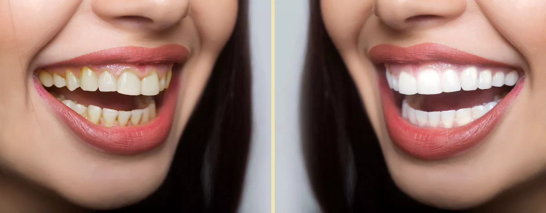 Before and after smile transformation at Pearl32 Dentistry