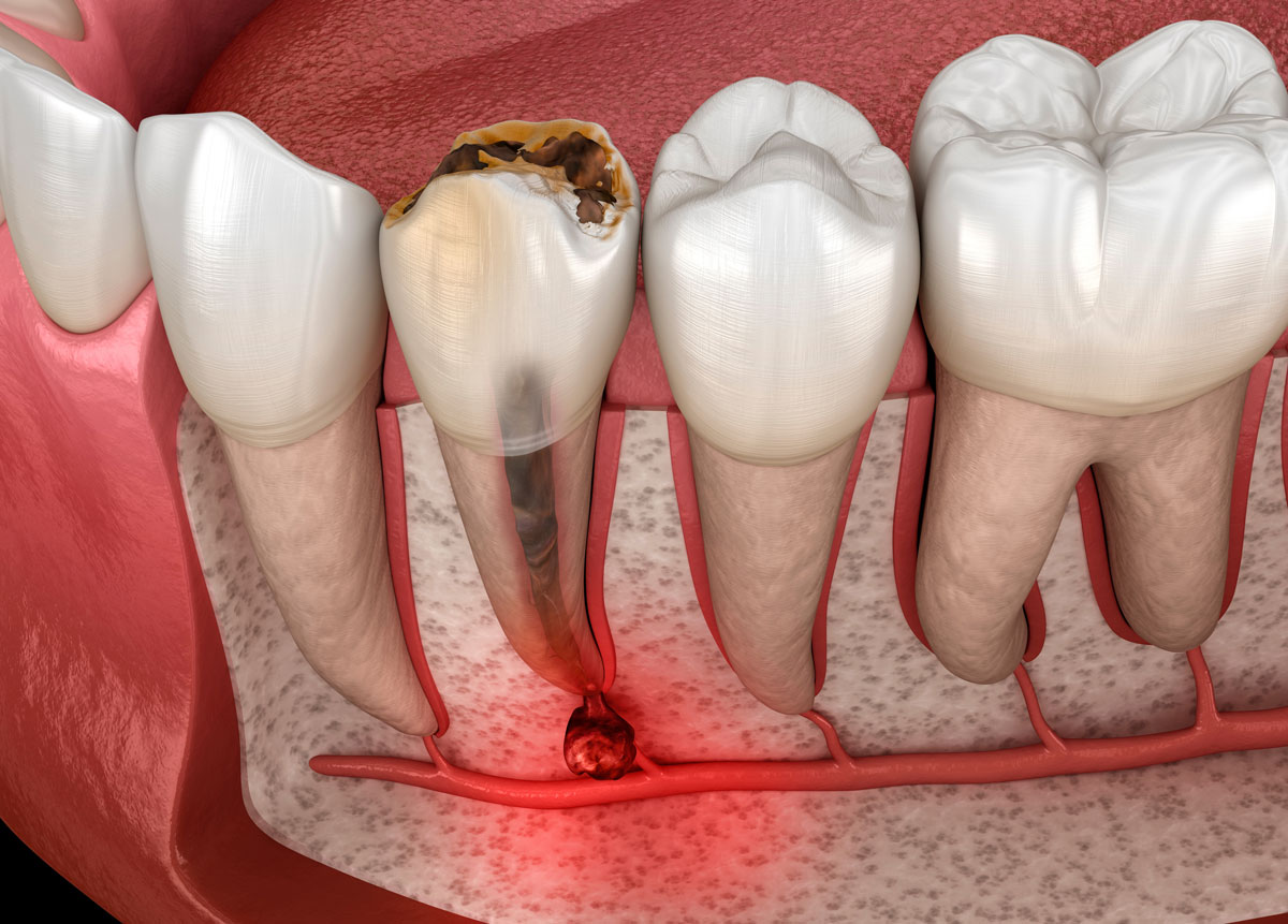 Diagram of root canal therapy on an infected tooth