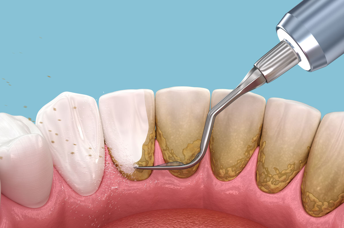Dental care at Pearl32 Dentistry and Wellness in Laguna Hills, CA